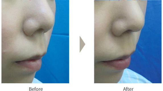 ガーデンクリニックの鼻中隔延長術の症例