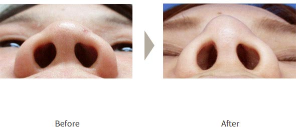 ガーデンクリニックの鼻のプロテーゼ、耳介軟骨移植の施術の症例
