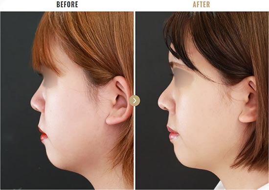 TAクリニックの鼻尖形成(オープン法)+軟骨移植の症例