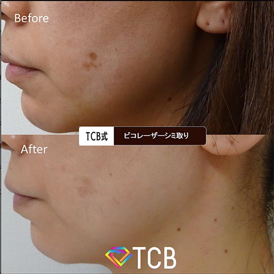 TCB東京中央美容外科のピコレーザーの症例
