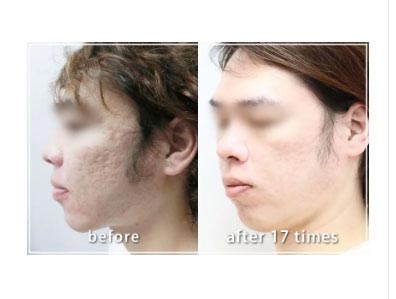共立美容外科のニキビ跡治療の症例