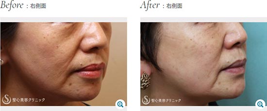 聖心美容クリニックのプレミアムPRP皮膚再生療法、ドクターハイフ（ウルセラシステム）の症例