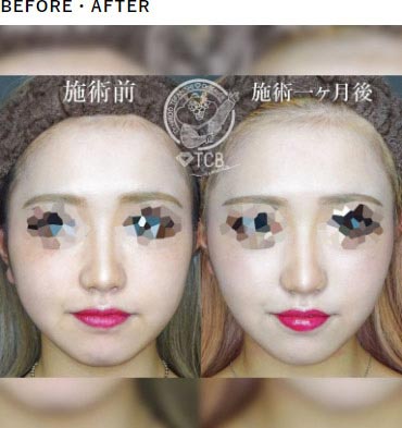 TCB東京中央美容外科の医療用HIFU（ハイフ） ソノクイーンの症例