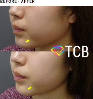 TCB東京中央美容外科の医療用HIFU（ハイフ） ソノクイーンの症例