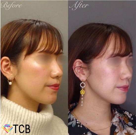 TCB東京中央美容外科の医療ハイフ（HIFU）ソノクイーンの症例