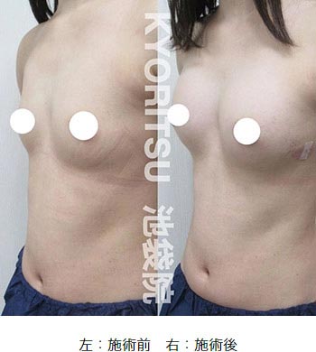 共立美容外科のシンデレラ豊胸術の症例