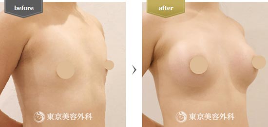 東京美容外科のシリコンバッグ豊胸の症例