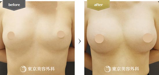 東京美容外科の豊胸ベラジェルの症例