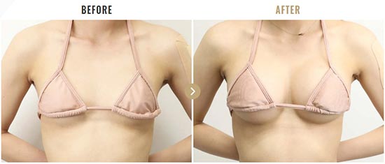 TAクリニックのシリコンバッグ豊胸（人工乳腺バッグ）の症例