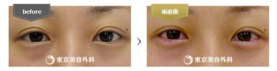東京美容外科のヒアルロン酸涙袋の症例