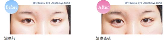 共立美容外科の涙袋ヒアルロン酸の症例