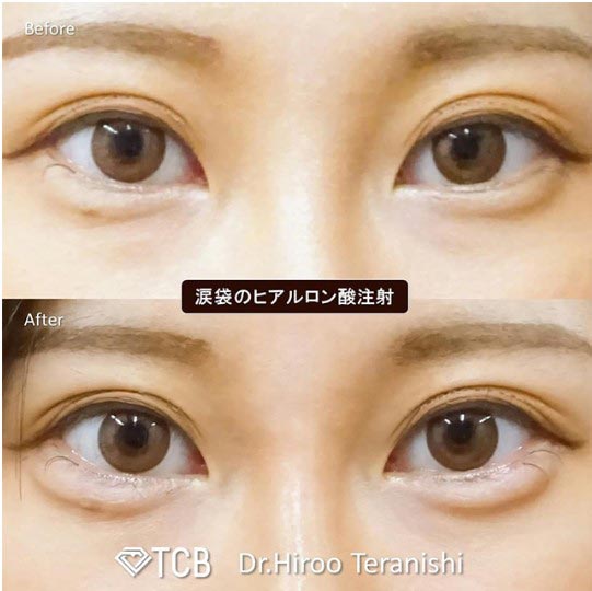 TCB東京中央美容外科のヒアルロン酸注射の症例