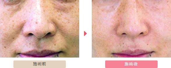大塚美容外科のフラクショナルレーザーによる肌の若返りの治療の症例