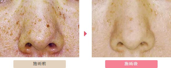 大塚美容外科のフラクショナルレーザー、CO2レーザーの症例
