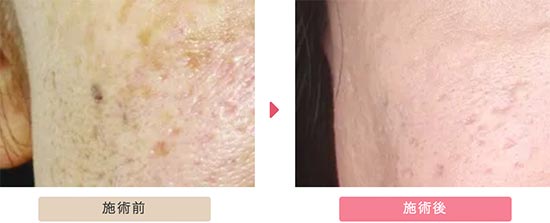 大塚美容外科のエルビウムヤグレーザー治療　フラクショナルレーザーの症例