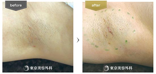 東京美容外科のワキガ・多汗症（吸引法）の症例