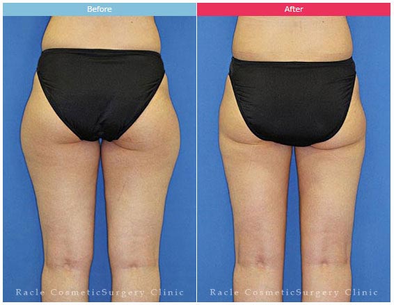 新宿ラクル美容外科クリニックの脂肪吸引（太もも全体・臀部・ひざ）の症例