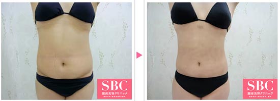 脂肪吸引（お腹）の施術前と施術1ヶ月後の症例写真