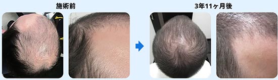 ゴリラクリニックのAGA治療　STOP（進行を止める）　GROW（髪を生やす、指令を出す）の症例