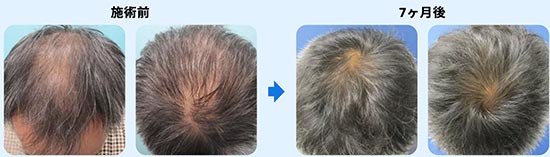 ゴリラクリニックのAGA治療　STOP（進行を止める）STRONG（毛を強く太く育てる）GROW（髪を生やす、指令を出す）CLEAN（頭皮環境を整えて発毛・育毛を土壌から支える）の症例
