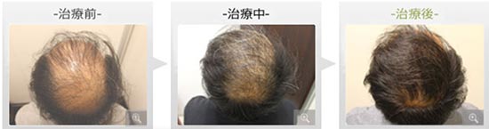 銀座総合美容クリニックの内服薬療法　ノーニードル育毛メソセラピーの症例