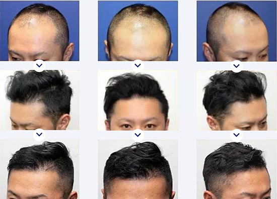 親和クリニックの生え際・前頭部・頭頂部・つむじの自毛植毛（MIRAI法）２０００株の症例