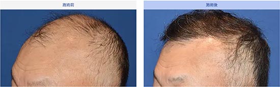 親和クリニックの生え際・前頭部の自毛植毛（MIRAI法）１８００株の症例
