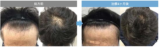 AGAオンラインクリニックの薄毛治療の症例