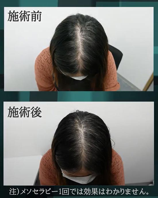 B＆Hメディカルクリニックの育毛メソセラピーの症例