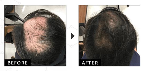 ウィルAGAクリニックの発毛トータルDXコースの症例