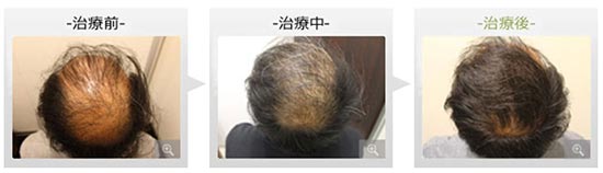 銀座総合美容クリニックの内服薬療法+ノーニードル育毛メソセラピーの症例