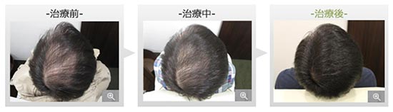 銀座総合美容クリニックの内服薬療法+クローズファクター育毛メソセラピーの症例
