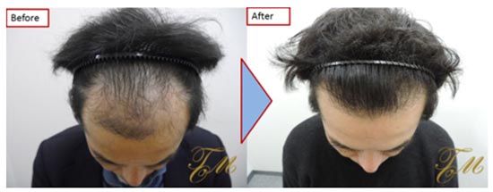 TOMクリニックのARTAS植毛の症例