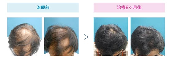 AGAスキンクリニックのオリジナル発毛薬「Rebirth」＋Dr’sメソ治療（AGAメソセラピー）の症例