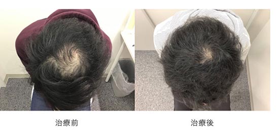 駅前AGAクリニックのオーダーメイドAGA発毛メソセラピー・AGA治療薬（内服/外用）の症例