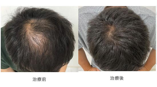 駅前AGAクリニックのオーダーメイドAGA発毛メソセラピー・AGA治療薬（内服/外用）の症例