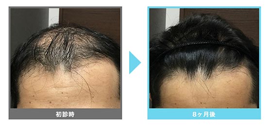 AGAメディカルケアクリニックのオリジナル発毛治療＋メディカルケア発毛メソセラピー（セット割）の症例