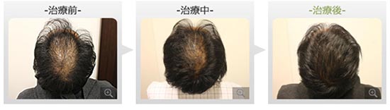 銀座総合美容クリニックの内服治療法＋ノーニードル育毛セラピーの症例