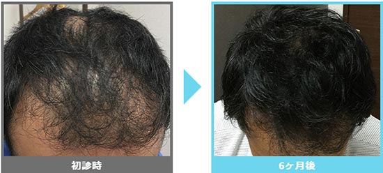 AGAメディカルケアクリニックの発毛治療の症例