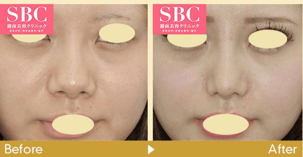 湘南美容クリニックの小鼻縮小術（フラップ法＋外側法）の症例