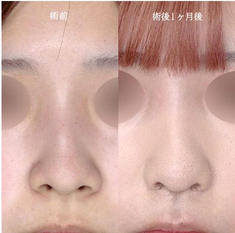 TCB東京中央美容外科のTCB式鼻翼縮小完全内側法 スタンダードの症例