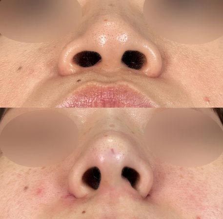 TCB東京中央美容外科の切らない小鼻縮小（鼻翼縮小埋没法） スタンダードの症例