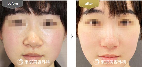東京美容外科の小鼻・鼻翼縮小(切開)の症例