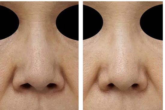 もとび美容外科クリニックの小鼻縮小（内側＋外側）の症例