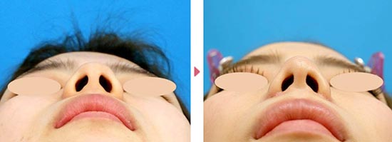 真崎医院の鼻翼縮小（切開）の症例