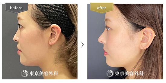 東京美容外科の鼻中隔延長、鼻尖形成、隆鼻術（プロテーゼ）の症例