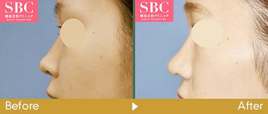 湘南美容クリニックの鼻尖形成術3D法＋軟骨移植＋小鼻縮小の症例