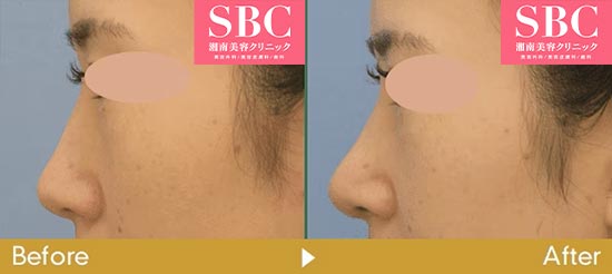 湘南美容クリニックの鼻尖形成３D法+移植軟骨の症例