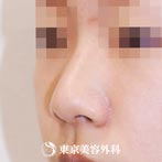 東京美容外科の鼻尖形成（切開法+軟骨移植）＋隆鼻術（オーダーメードプロテーゼ）の症例