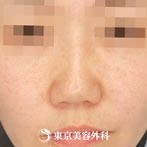 東京美容外科の鼻尖形成、鼻中隔延長、隆鼻術（他院修正）の症例